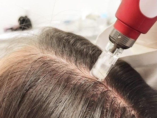 BONO 5 SESIONES DE DERMAPEN + EXOSOMAS CAPILAR