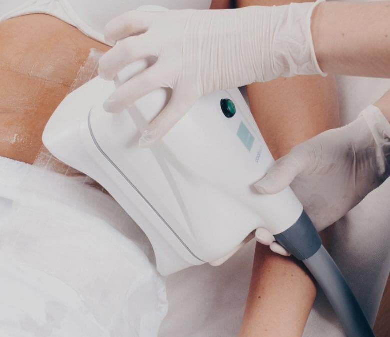 Foto 1 CRIOLIPOLISIS (1ZONA)