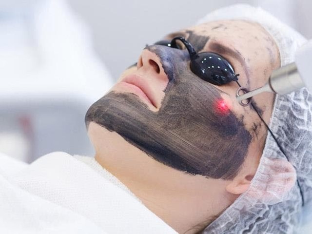 PEELING CARBÓN ACTIVO LASER Q-SWITCHED